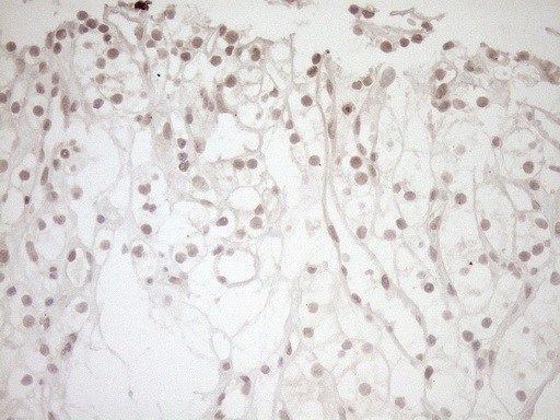 NR1I3 / CAR Antibody - Immunohistochemical staining of paraffin-embedded Carcinoma of Human kidney tissue using anti-NR1I3 mouse monoclonal antibody. (Heat-induced epitope retrieval by 1mM EDTA in 10mM Tris buffer. (pH8.5) at 120°C for 3 min. (1:150)