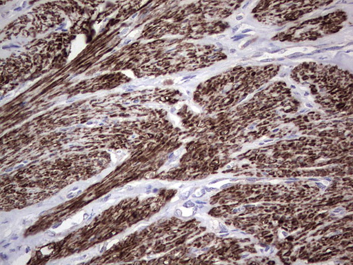 NR1I3 / CAR Antibody - Immunohistochemical staining of paraffin-embedded Adenocarcinoma of Human endometrium tissue using anti-NR1I3 mouse monoclonal antibody. (Heat-induced epitope retrieval by 1 mM EDTA in 10mM Tris, pH8.5, 120C for 3min,