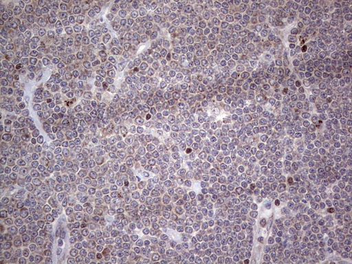 NR1I3 / CAR Antibody - Immunohistochemical staining of paraffin-embedded Human lymphoma tissue using anti-NR1I3 mouse monoclonal antibody. (Heat-induced epitope retrieval by 1 mM EDTA in 10mM Tris, pH8.5, 120C for 3min,