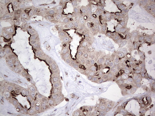 NR1I3 / CAR Antibody - Immunohistochemical staining of paraffin-embedded Carcinoma of Human liver tissue using anti-NR1I3 mouse monoclonal antibody. (Heat-induced epitope retrieval by 1 mM EDTA in 10mM Tris, pH8.5, 120C for 3min,
