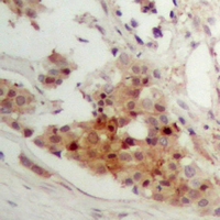 NR1I3 / CAR Antibody - Immunohistochemical analysis of CAR staining in human breast cancer formalin fixed paraffin embedded tissue section. The section was pre-treated using heat mediated antigen retrieval with sodium citrate buffer (pH 6.0). The section was then incubated with the antibody at room temperature and detected using an HRP polymer system. DAB was used as the chromogen. The section was then counterstained with hematoxylin and mounted with DPX.