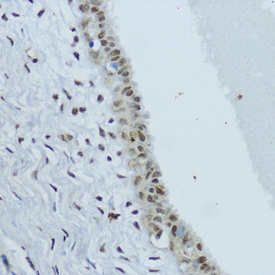 NR1I3 / CAR Antibody - Immunohistochemistry of paraffin-embedded Human mammary cancer using NR1I3 Polyclonal Antibody at dilution of 1:200 (40x lens).