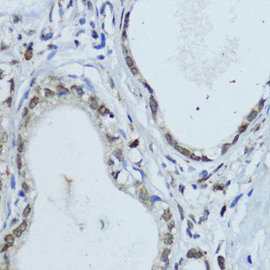 NR1I3 / CAR Antibody - Immunohistochemistry of paraffin-embedded Human gastric cancer using NR1I3 Polyclonal Antibody at dilution of 1:200 (40x lens).