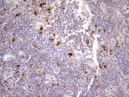 NR2C2 / TAK1 Antibody - Immunohistochemical staining of paraffin-embedded Carcinoma of Human lung tissue using anti-NR2C2 mouse monoclonal antibody. (Heat-induced epitope retrieval by 1 mM EDTA in 10mM Tris, pH8.5, 120C for 3min. (1:150)