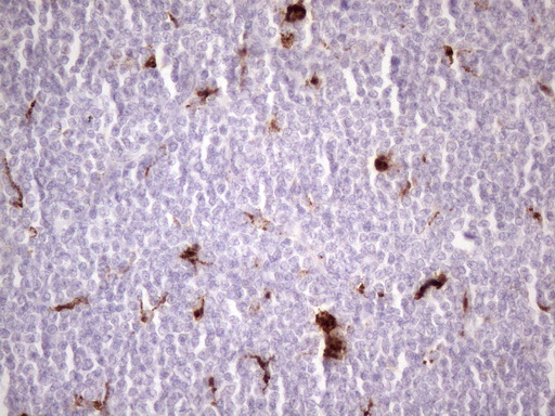 NR2C2 / TAK1 Antibody - Immunohistochemical staining of paraffin-embedded Human lymphoma tissue using anti-NR2C2 mouse monoclonal antibody. (Heat-induced epitope retrieval by 1 mM EDTA in 10mM Tris, pH8.5, 120C for 3min. (1:150)