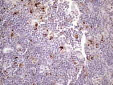 NR2C2 / TAK1 Antibody - IHC of paraffin-embedded Carcinoma of Human lung tissue using anti-NR2C2 mouse monoclonal antibody. (Heat-induced epitope retrieval by 1 mM EDTA in 10mM Tris, pH8.5, 120°C for 3min)(1:150).