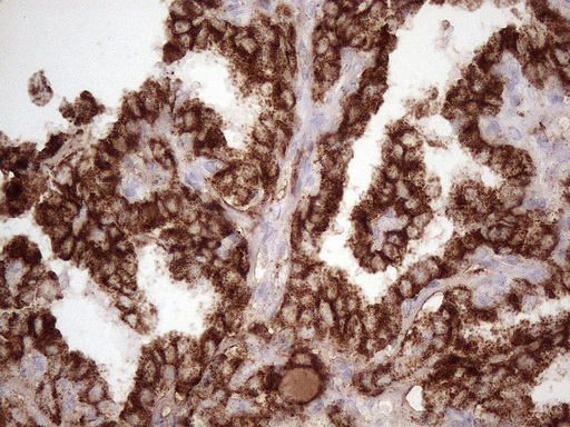NR2C2 / TAK1 Antibody - IHC of paraffin-embedded Carcinoma of Human thyroid tissue using anti-NR2C2 mouse monoclonal antibody. (Heat-induced epitope retrieval by 1 mM EDTA in 10mM Tris, pH8.5, 120°C for 3min)(1:150).