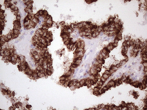 NR2C2 / TAK1 Antibody - Immunohistochemical staining of paraffin-embedded Carcinoma of Human thyroid tissue using anti-NR2C2 mouse monoclonal antibody. (Heat-induced epitope retrieval by 1 mM EDTA in 10mM Tris, pH8.5, 120C for 3min. (1:150)
