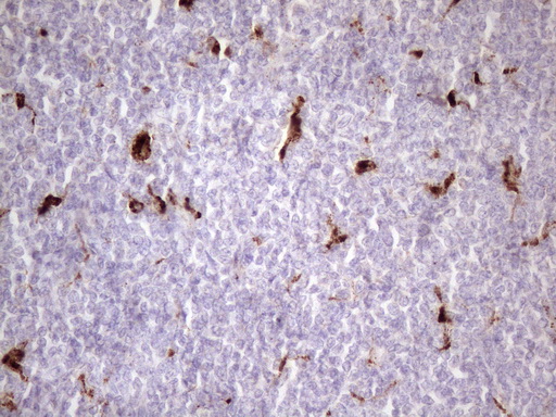 NR2C2 / TAK1 Antibody - Immunohistochemical staining of paraffin-embedded Human lymphoma tissue using anti-NR2C2 mouse monoclonal antibody. (Heat-induced epitope retrieval by 1 mM EDTA in 10mM Tris, pH8.5, 120C for 3min. (1:150)