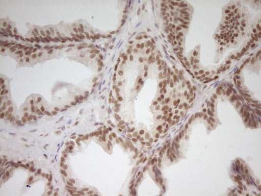 NR2C2 / TAK1 Antibody - Immunohistochemical staining of paraffin-embedded Carcinoma of Human prostate tissue using anti-NR2C2 mouse monoclonal antibody. (Heat-induced epitope retrieval by 1 mM EDTA in 10mM Tris, pH8.5, 120C for 3min,