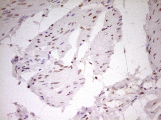 NR2C2 / TAK1 Antibody - Immunohistochemical staining of paraffin-embedded Carcinoma of Human bladder tissue using anti-NR2C2 mouse monoclonal antibody. (Heat-induced epitope retrieval by 1 mM EDTA in 10mM Tris, pH8.5, 120C for 3min,