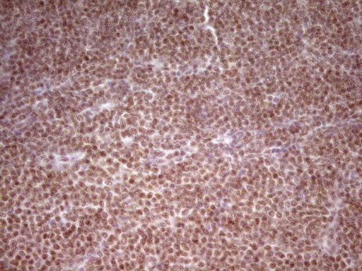 NR2C2 / TAK1 Antibody - Immunohistochemical staining of paraffin-embedded Human lymphoma tissue using anti-NR2C2 mouse monoclonal antibody. (Heat-induced epitope retrieval by 1 mM EDTA in 10mM Tris, pH8.5, 120C for 3min,