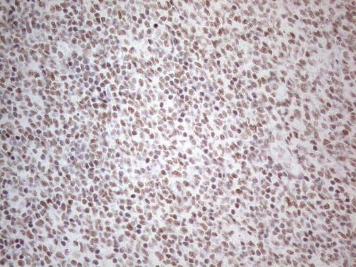 NR2C2 / TAK1 Antibody - Immunohistochemical staining of paraffin-embedded Human lymphoma tissue using anti-NR2C2 mouse monoclonal antibody. (Heat-induced epitope retrieval by 1mM EDTA in 10mM Tris buffer. (pH8.5) at 120°C for 3 min. (1:150)
