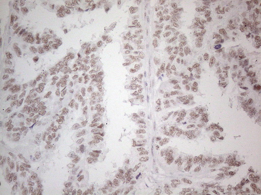 NR2C2 / TAK1 Antibody - Immunohistochemical staining of paraffin-embedded Adenocarcinoma of Human ovary tissue using anti-NR2C2 mouse monoclonal antibody. (Heat-induced epitope retrieval by 1mM EDTA in 10mM Tris buffer. (pH8.5) at 120°C for 3 min. (1:150)