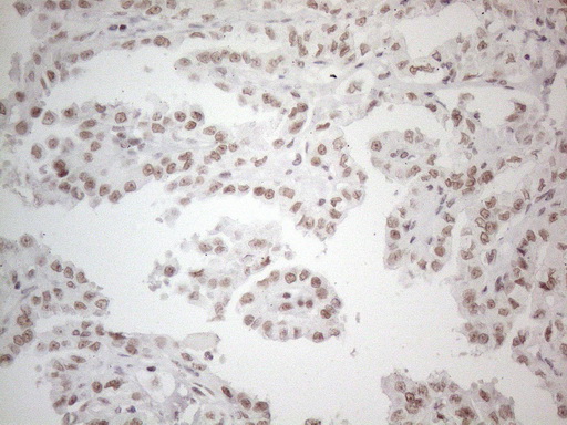 NR2C2 / TAK1 Antibody - Immunohistochemical staining of paraffin-embedded Carcinoma of Human thyroid tissue using anti-NR2C2 mouse monoclonal antibody. (Heat-induced epitope retrieval by 1mM EDTA in 10mM Tris buffer. (pH8.5) at 120°C for 3 min. (1:150)