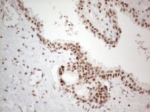 NR2C2 / TAK1 Antibody - Immunohistochemical staining of paraffin-embedded Carcinoma of Human prostate tissue using anti-NR2C2 mouse monoclonal antibody. (Heat-induced epitope retrieval by 1mM EDTA in 10mM Tris buffer. (pH8.5) at 120°C for 3 min. (1:150)