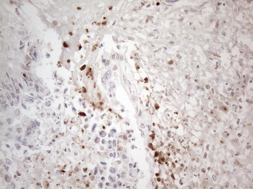 NR2C2 / TAK1 Antibody - Immunohistochemical staining of paraffin-embedded Adenocarcinoma of Human colon tissue using anti-NR2C2 mouse monoclonal antibody. (Heat-induced epitope retrieval by 1mM EDTA in 10mM Tris buffer. (pH8.5) at 120°C for 3 min. (1:150)