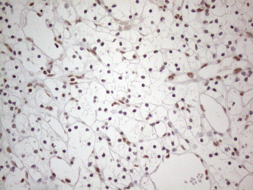 NR2C2 / TAK1 Antibody - Immunohistochemical staining of paraffin-embedded Carcinoma of Human kidney tissue using anti-NR2C2 mouse monoclonal antibody. (Heat-induced epitope retrieval by 1mM EDTA in 10mM Tris buffer. (pH8.5) at 120°C for 3 min. (1:150)