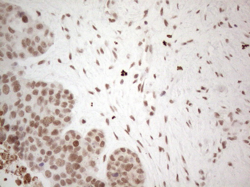 NR2C2 / TAK1 Antibody - Immunohistochemical staining of paraffin-embedded Adenocarcinoma of Human endometrium tissue using anti-NR2C2 mouse monoclonal antibody. (Heat-induced epitope retrieval by 1mM EDTA in 10mM Tris buffer. (pH8.5) at 120°C for 3 min. (1:150)