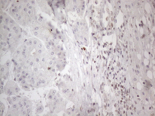 NR2C2 / TAK1 Antibody - Immunohistochemical staining of paraffin-embedded Carcinoma of Human liver tissue using anti-NR2C2 mouse monoclonal antibody. (Heat-induced epitope retrieval by 1mM EDTA in 10mM Tris buffer. (pH8.5) at 120°C for 3 min. (1:150)