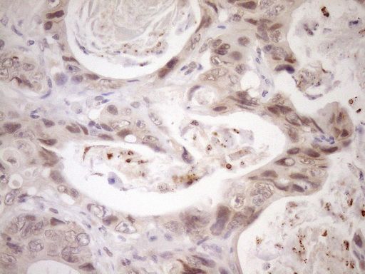 NR2C2 / TAK1 Antibody - Immunohistochemical staining of paraffin-embedded Adenocarcinoma of Human colon tissue using anti-NR2C2 mouse monoclonal antibody. (Heat-induced epitope retrieval by Tris-EDTA, pH8.0)(1:150)