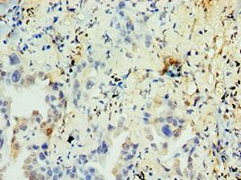 NR2C2 / TAK1 Antibody - Immunohistochemistry of paraffin-embedded human lung cancer using antibody at 1:100 dilution.