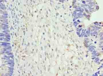 NR2C2AP / TRA16 Antibody - Immunohistochemistry of paraffin-embedded human ovarian cancer using antibody at dilution of 1:100.