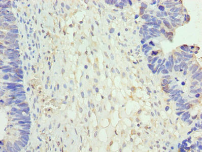 NR2C2AP / TRA16 Antibody - Immunohistochemistry of paraffin-embedded human ovarian cancer using NR2C2AP Antibody at dilution of 1:100