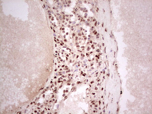 NR3C1/Glucocorticoid Receptor Antibody - IHC of paraffin-embedded Human lymph node tissue using anti-NR3C1 mouse monoclonal antibody. (Heat-induced epitope retrieval by 1 mM EDTA in 10mM Tris, pH8.5, 120°C for 3min).