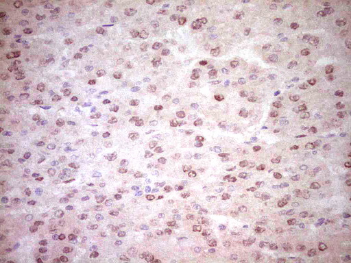 NR3C1/Glucocorticoid Receptor Antibody - IHC of paraffin-embedded Carcinoma of Human liver tissue using anti-NR3C1 mouse monoclonal antibody. (Heat-induced epitope retrieval by 1 mM EDTA in 10mM Tris, pH8.5, 120°C for 3min).