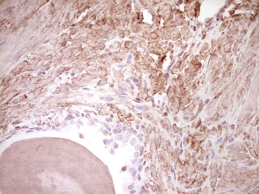 NR3C1/Glucocorticoid Receptor Antibody - IHC of paraffin-embedded Human prostate tissue using anti-NR3C1 mouse monoclonal antibody. (Heat-induced epitope retrieval by 1 mM EDTA in 10mM Tris, pH8.5, 120°C for 3min).