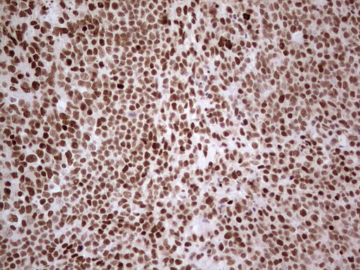 NR3C1/Glucocorticoid Receptor Antibody - Immunohistochemical staining of paraffin-embedded Human tonsil within the normal limits using anti-NR3C1 mouse monoclonal antibody. (Heat-induced epitope retrieval by 1 mM EDTA in 10mM Tris, pH8.5, 120C for 3min,