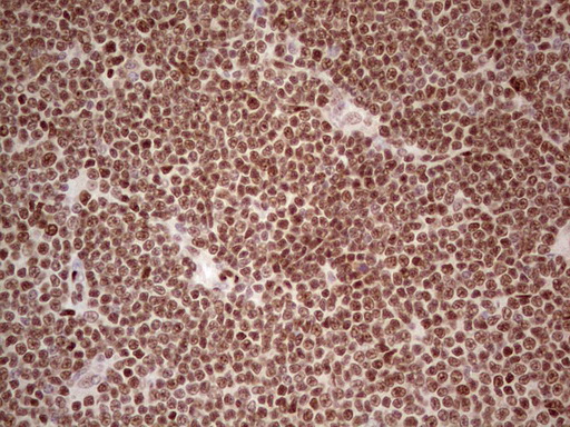 NR3C1/Glucocorticoid Receptor Antibody - IHC of paraffin-embedded Human lymphoma tissue using anti-NR3C1 mouse monoclonal antibody. (Heat-induced epitope retrieval by 1 mM EDTA in 10mM Tris, pH8.5, 120°C for 3min).