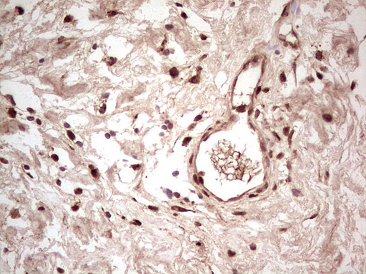 NR3C1/Glucocorticoid Receptor Antibody - IHC of paraffin-embedded Carcinoma of Human bladder tissue using anti-NR3C1 mouse monoclonal antibody. (Heat-induced epitope retrieval by 1 mM EDTA in 10mM Tris, pH8.5, 120°C for 3min).