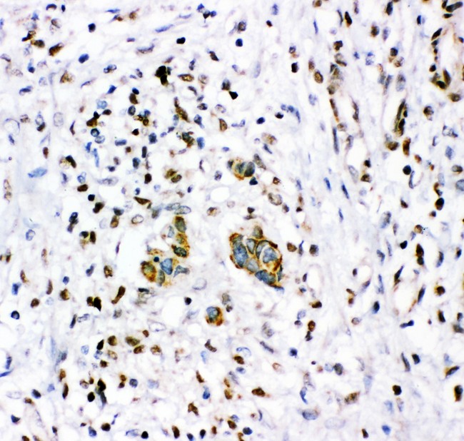NR3C1/Glucocorticoid Receptor Antibody - NR3C1 antibody IHC-paraffin: Human Mammary Cancer Tissue.