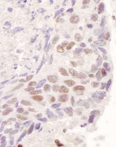 NR3C1/Glucocorticoid Receptor Antibody - Detection of Human GR by Immunohistochemistry. Sample: FFPE section of human non-small cell lung cancer. Antibody: Affinity purified rabbit anti-GR used at a dilution of 1:200 (1 ug/ml). Detection: DAB.