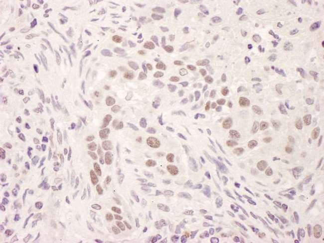 NR3C1/Glucocorticoid Receptor Antibody - Detection of Human GR by Immunohistochemistry. Sample: FFPE section of human lung carcinoma. Antibody: Affinity purified rabbit anti-GR used at a dilution of 1:200 (1 ug/ml). Detection: DAB.