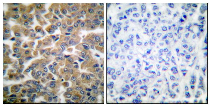 NR3C1/Glucocorticoid Receptor Antibody - Immunohistochemistry analysis of paraffin-embedded human breast carcinoma tissue, using GR Antibody. The picture on the right is blocked with the synthesized peptide.
