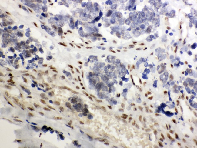 NR3C1/Glucocorticoid Receptor Antibody - NR3C1 antibody IHC-paraffin: Human Lung Cancer Tissue.
