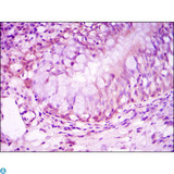 NR3C1/Glucocorticoid Receptor Antibody - Immunohistochemistry (IHC) analysis of paraffin-embedded Lung Cancer Tissues with DAB staining using GR Monoclonal Antibody.