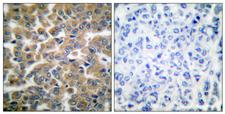 NR3C1/Glucocorticoid Receptor Antibody - Peptide - + Immunohistochemical analysis of paraffin-embedded human breast carcinoma tissue using GR (Ab-211) antibody.