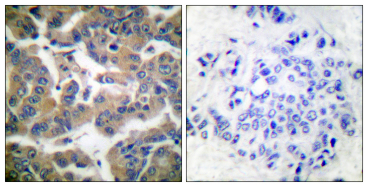 NR3C1/Glucocorticoid Receptor Antibody - Immunohistochemistry analysis of paraffin-embedded human breast carcinoma, using GR (Phospho-Ser211) Antibody. The picture on the right is blocked with the phospho peptide.