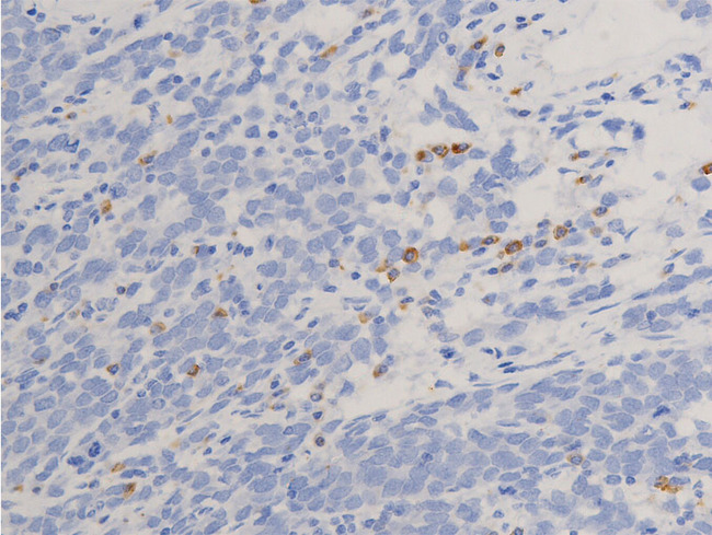 NR3C1/Glucocorticoid Receptor Antibody - 1:100 staining human colon carcinoma tissue by IHC-P. The tissue was formaldehyde fixed and a heat mediated antigen retrieval step in citrate buffer was performed. The tissue was then blocked and incubated with the antibody for 1.5 hours at 22°C. An HRP conjugated goat anti-rabbit antibody was used as the secondary.