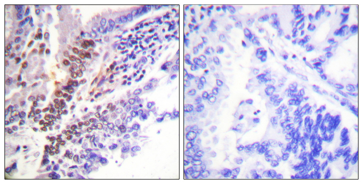 NR3C1/Glucocorticoid Receptor Antibody - Immunohistochemistry analysis of paraffin-embedded human lung carcinoma, using GR (Phospho-Ser226) Antibody. The picture on the right is blocked with the phospho peptide.