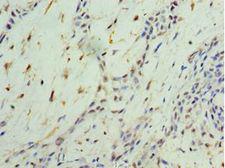NR4A1 / NUR77 Antibody - Immunohistochemistry of paraffin-embedded human breast cancer using antibody at 1:100 dilution.