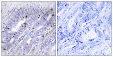 NR4A1 / NUR77 Antibody - Immunohistochemistry analysis of paraffin-embedded human colon carcinoma tissue, using Nuclear Receptor NR4A1 Antibody. The picture on the right is blocked with the synthesized peptide.