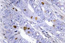 NR4A1 / NUR77 Antibody - IHC of Nur77/NR4A1 (G347) pAb in paraffin-embedded human colon carcinoma tissue.