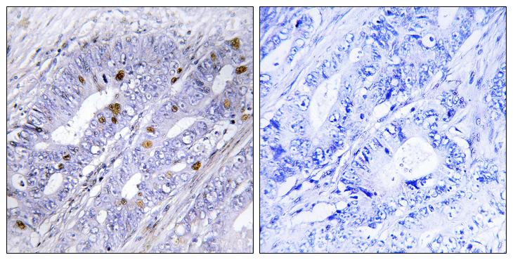NR4A1 / NUR77 Antibody - Peptide - + Immunohistochemistry analysis of paraffin-embedded human colon carcinoma tissue using Nuclear Receptor NR4A1 (Ab-351) antibody.