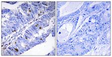 NR4A1 / NUR77 Antibody - Immunohistochemistry analysis of paraffin-embedded human colon carcinoma, using Nuclear Receptor NR4A1 (Phospho-Ser351) Antibody. The picture on the right is blocked with the phospho peptide.