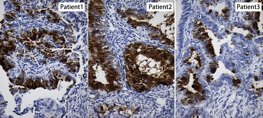 NR5A1 / SF1 Antibody - Immunohistochemical staining of paraffin-embedded Adenocarcinoma of Human endometrium tissue from three different patients using anti-NR5A1 mouse monoclonal antibody. (Heat-induced epitope retrieval by 1mM EDTA in 10mM Tris buffer. (pH8.0) at 120°C for 3 min. (1:200)